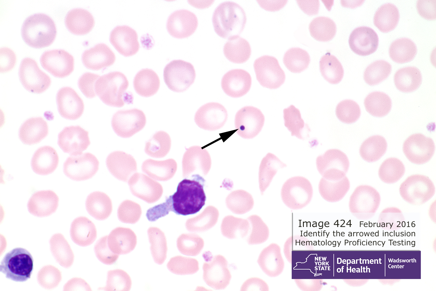 hematology-pt-image-424