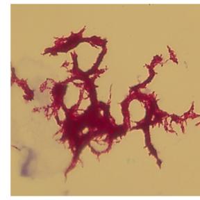 Corded TB acid fast stained by Ziehl-Neelsen method