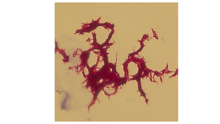 Corded TB acid fast stained by Ziehl-Neelsen method