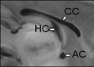 Mid-sagittal view of FVB (left) and BTBR (right) brains, illustrating forebrain commissure differences between the two strains.