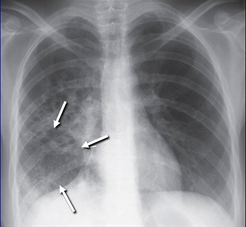 Chest radiograph with lower lobe activity. Credit: CDC