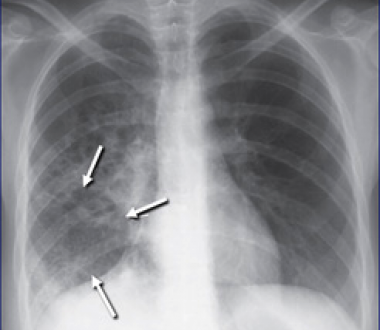 Chest radiograph with lower lobe activity. Credit: CDC Chest radiograph with lower lobe activity. Credit: CDC