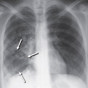 Chest radiograph with lower lobe activity. Credit: CDC